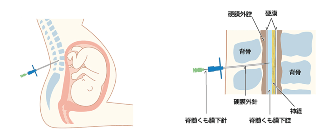 硬膜外麻酔による無痛分娩